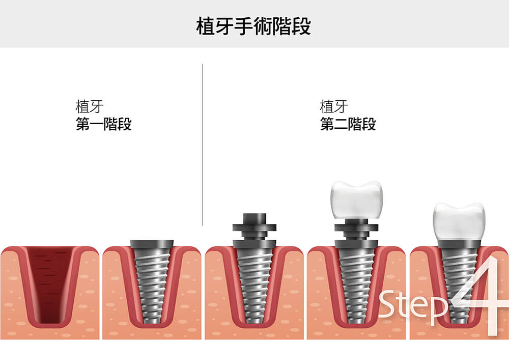 數位植牙手術流程 4