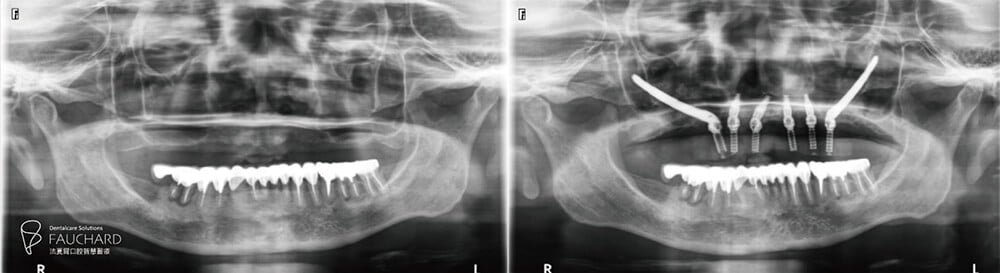 全口重建案例-術式介紹