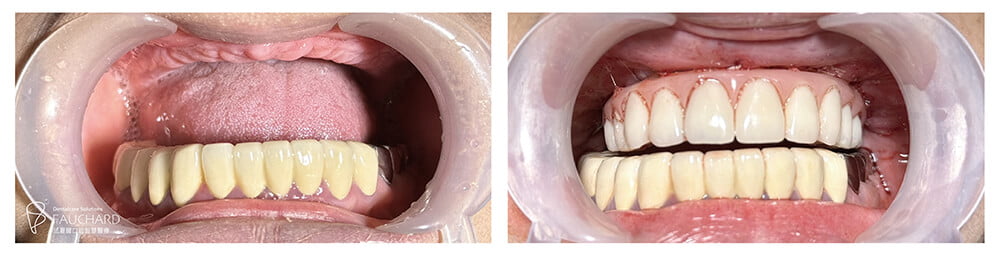 全口重建成功案例