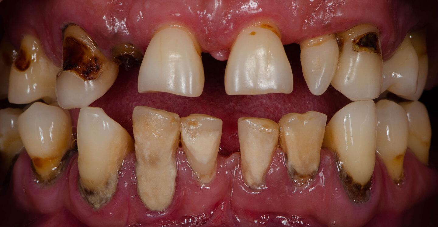 teeth implant 2502 3