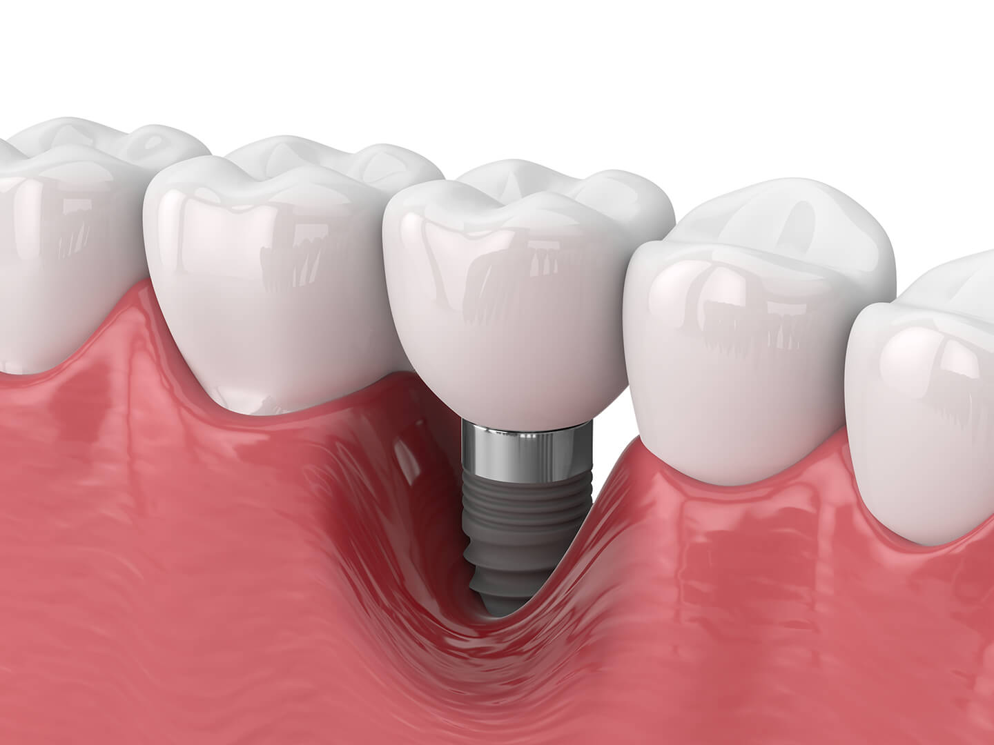 teeth implant 2502 6